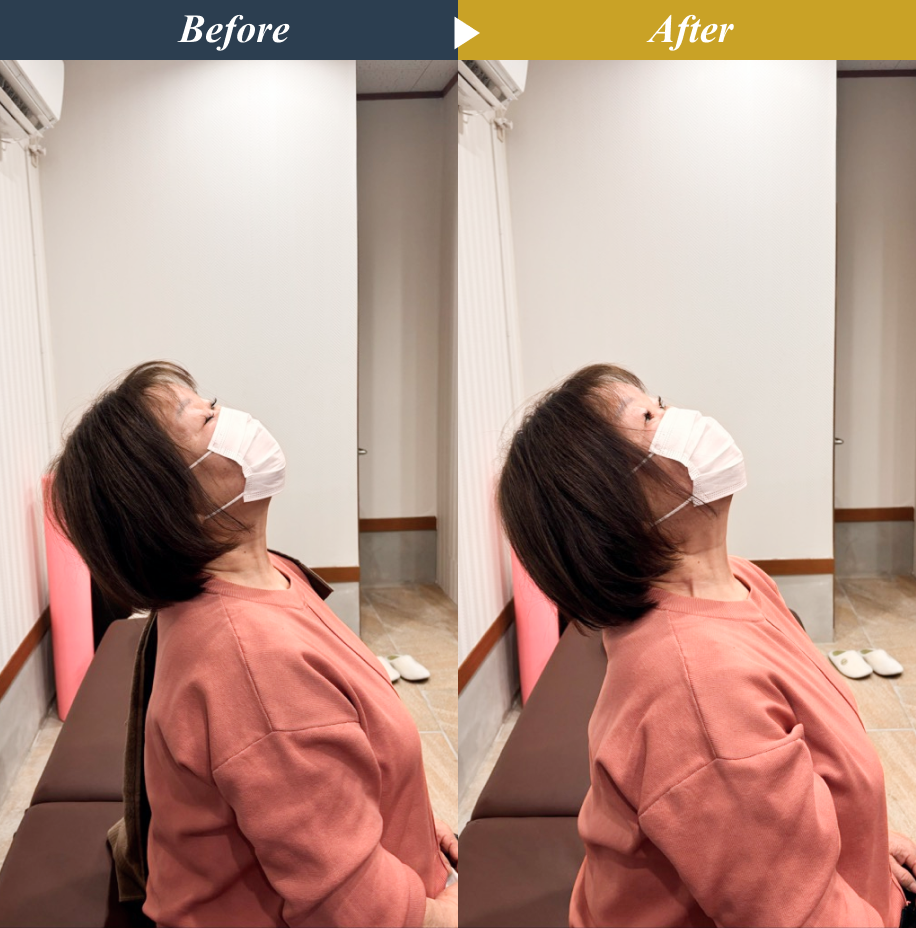 Make One’s World整体院 矢川店のストレッチ整体とエクササイズによる姿勢改善のビフォーアフター事例3